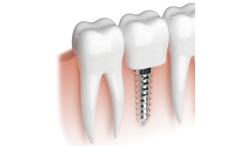 Smile Designers corona de zirconio Odontología Estética